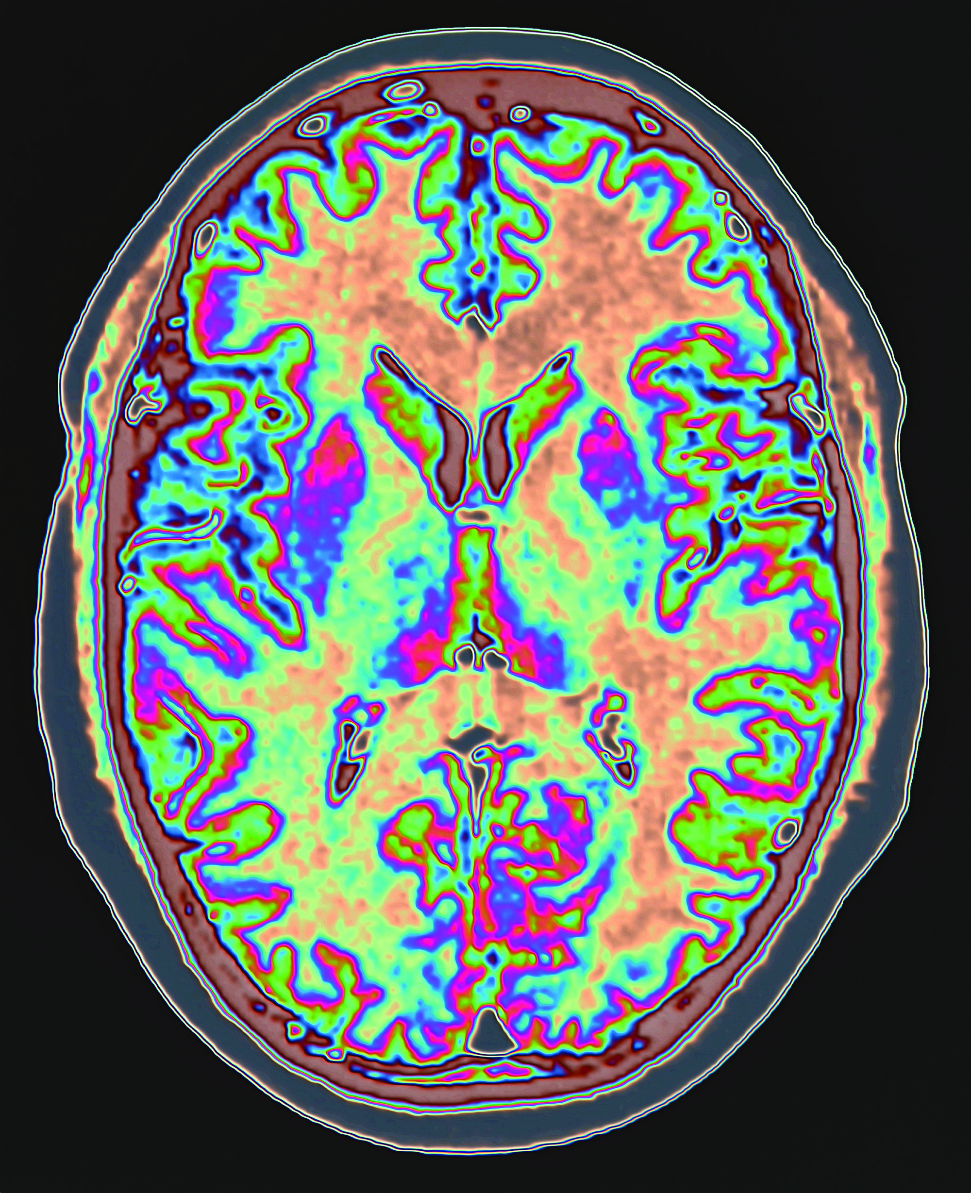 dementia research study florida